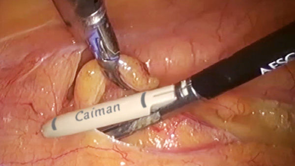 EinsteinVision® in de laparoscopische chirurgie met autofocus-effect