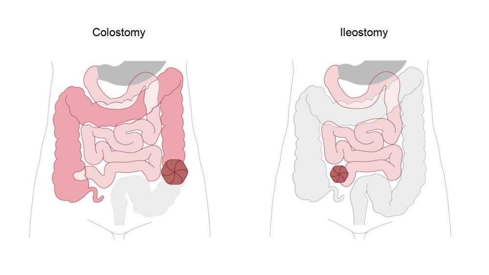 illustratie van colostoma en ileostoma