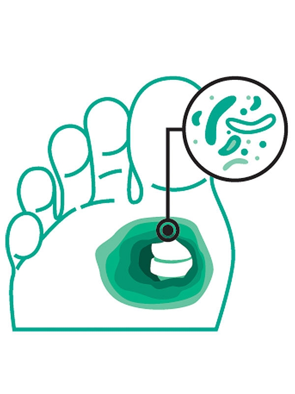 Voetpictogram met een groter gemarkeerd gebied en bacteriën op het bot, wat wijst op een matige infectie.