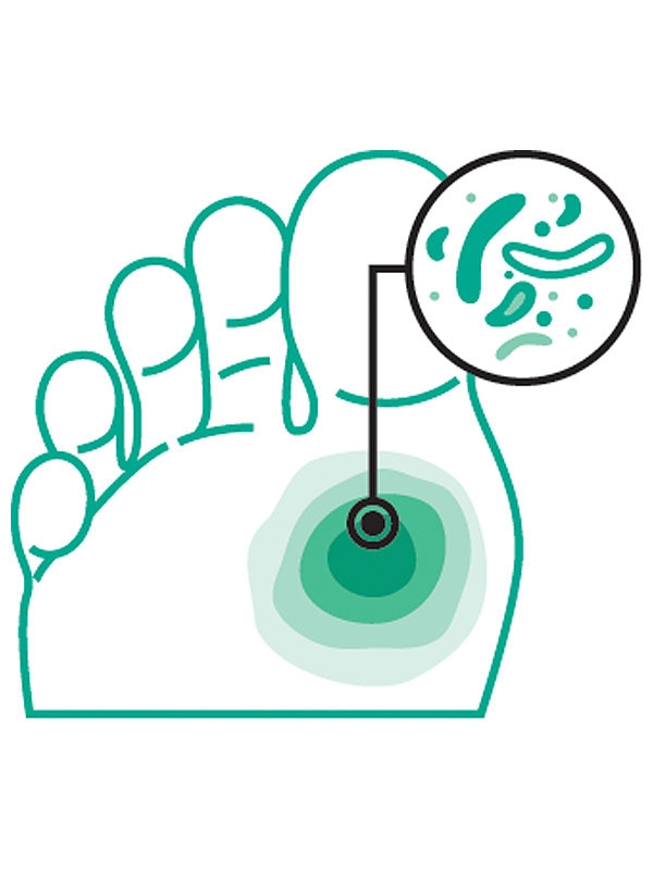 Voetpictogram met een geaccentueerd ulcus en bacteriepictogrammen, die tekenen van infectie vertegenwoordigen.