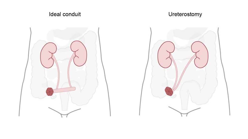 illustratie van ileale condui en ureterostomie