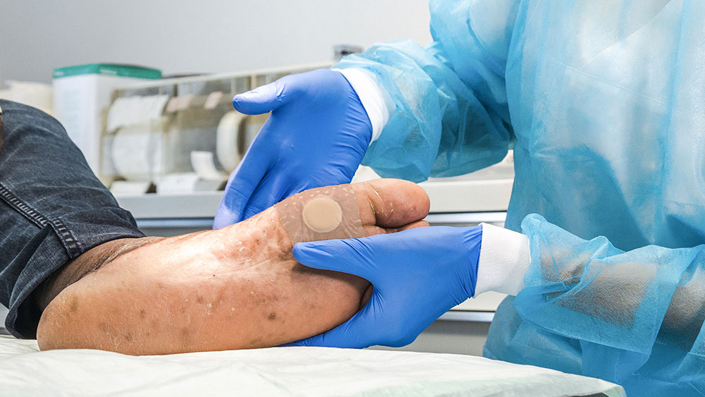 voet met pleister en verpleegkundige diabetisch voetsyndroom