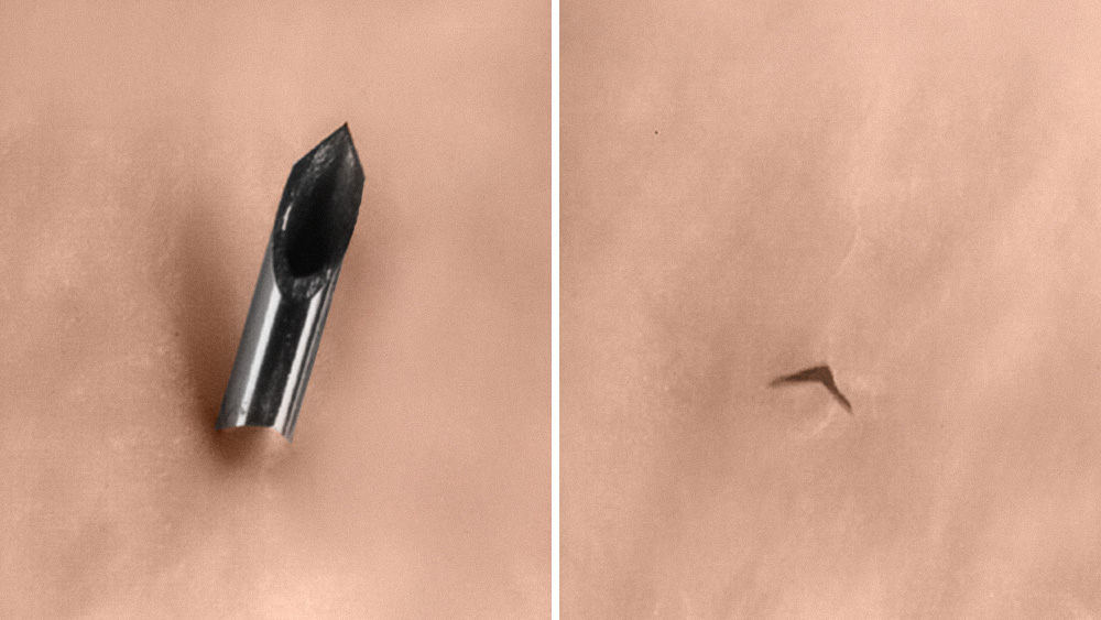 Close-up vergelijking met een afgeschuinde medische naaldpunt links en een kleine punctiemarkering op de huid rechts, beide tegen een lichte huidskleurige achtergrond
