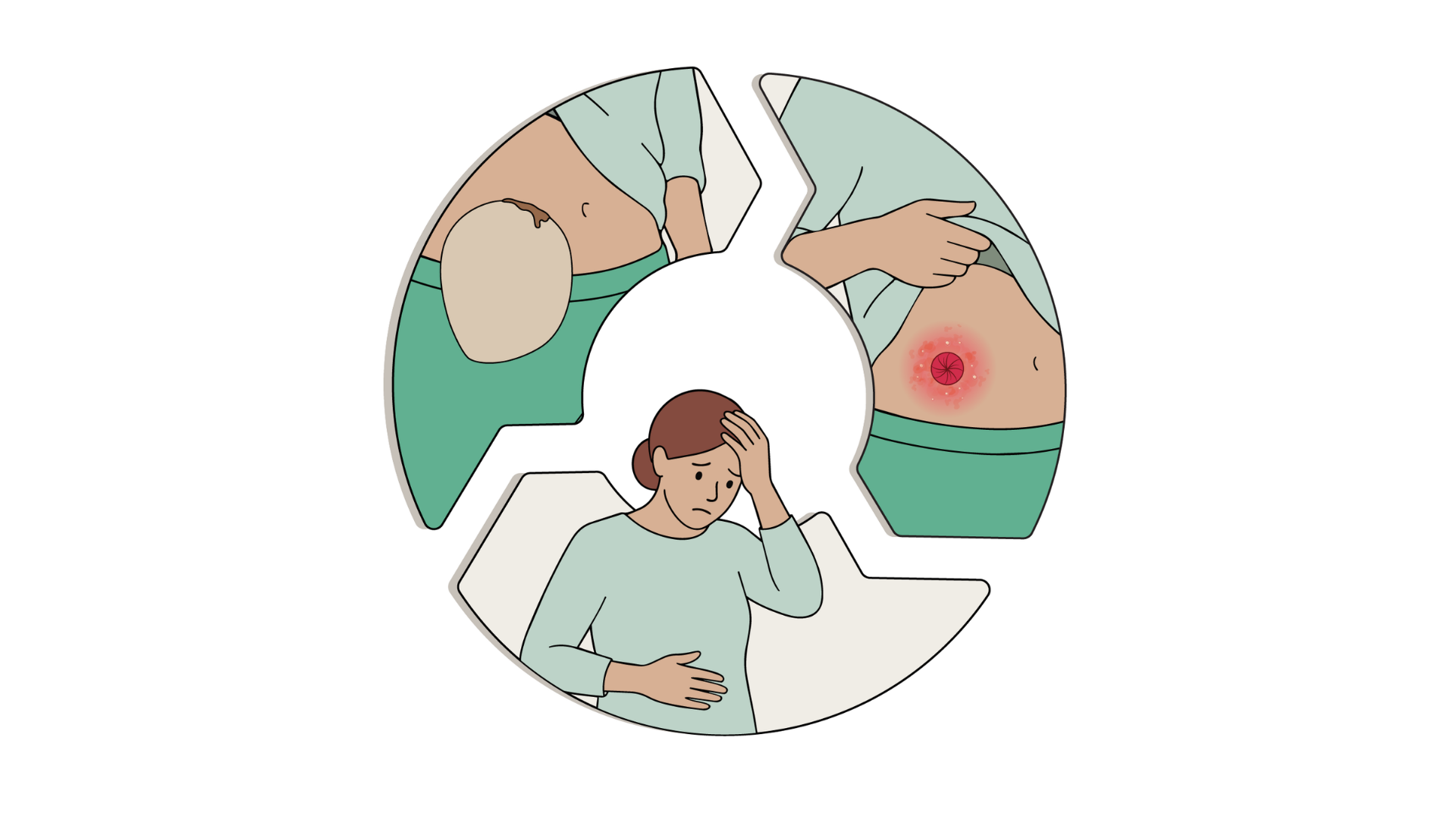 Illustratie van de vicieuze cirkel van stomacomplicaties. 'Stomalekkage’ leidt tot ‘Huidirritatie’, wat vervolgens een negatieve ‘Impact op de kwaliteit van leven’ veroorzaakt. Dit wordt geïllustreerd door een vrouw die zich zichtbaar ongemakkelijk of bezorgd voelt.