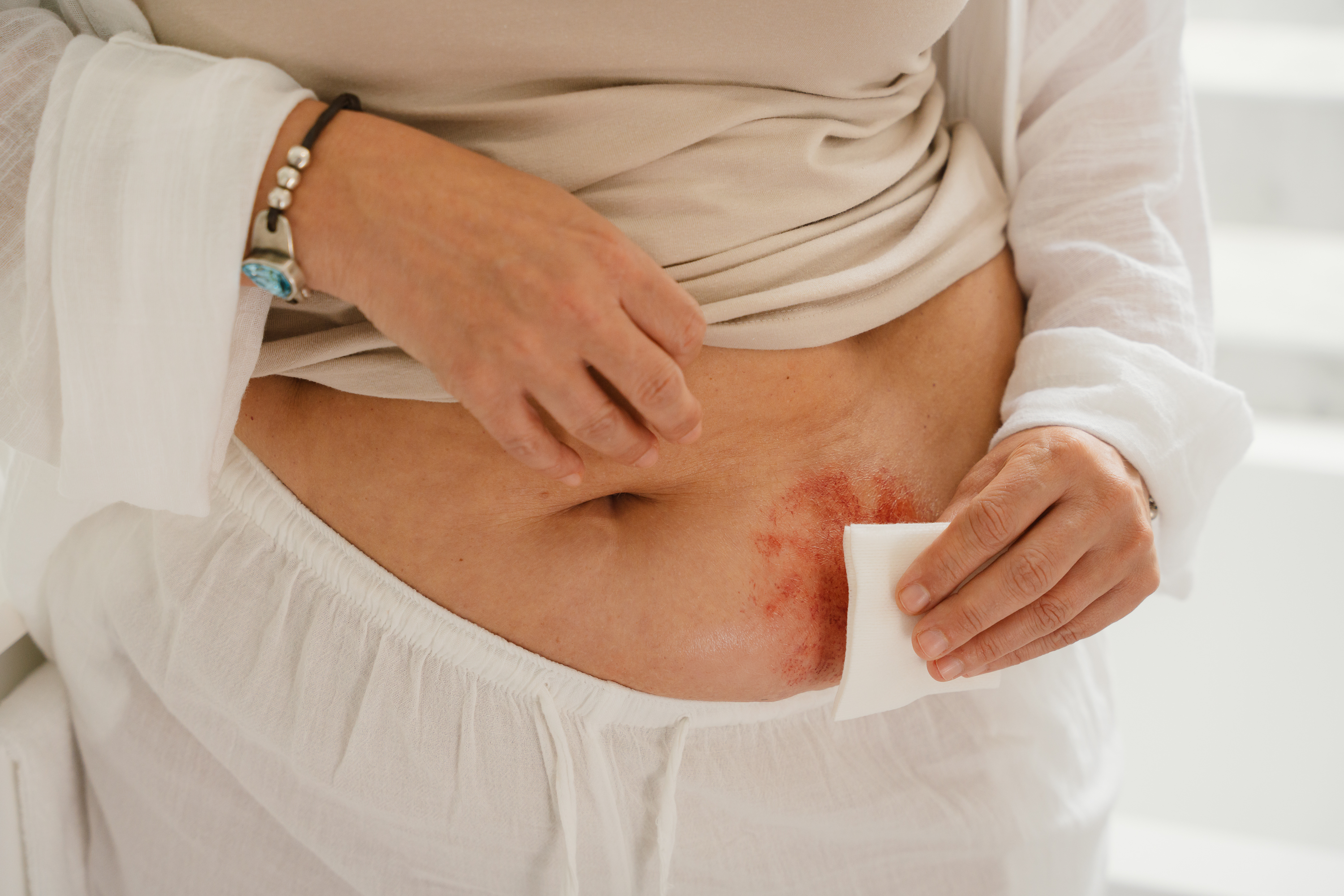 Close-up van een persoon met rode huidirritatie rond de stoma, die een wit medisch gaas gebruikt om de peristomale huid op zijn buik voorzichtig te reinigen. De persoon draagt lichtgekleurde kleding en een armband met kralen om zijn pols.