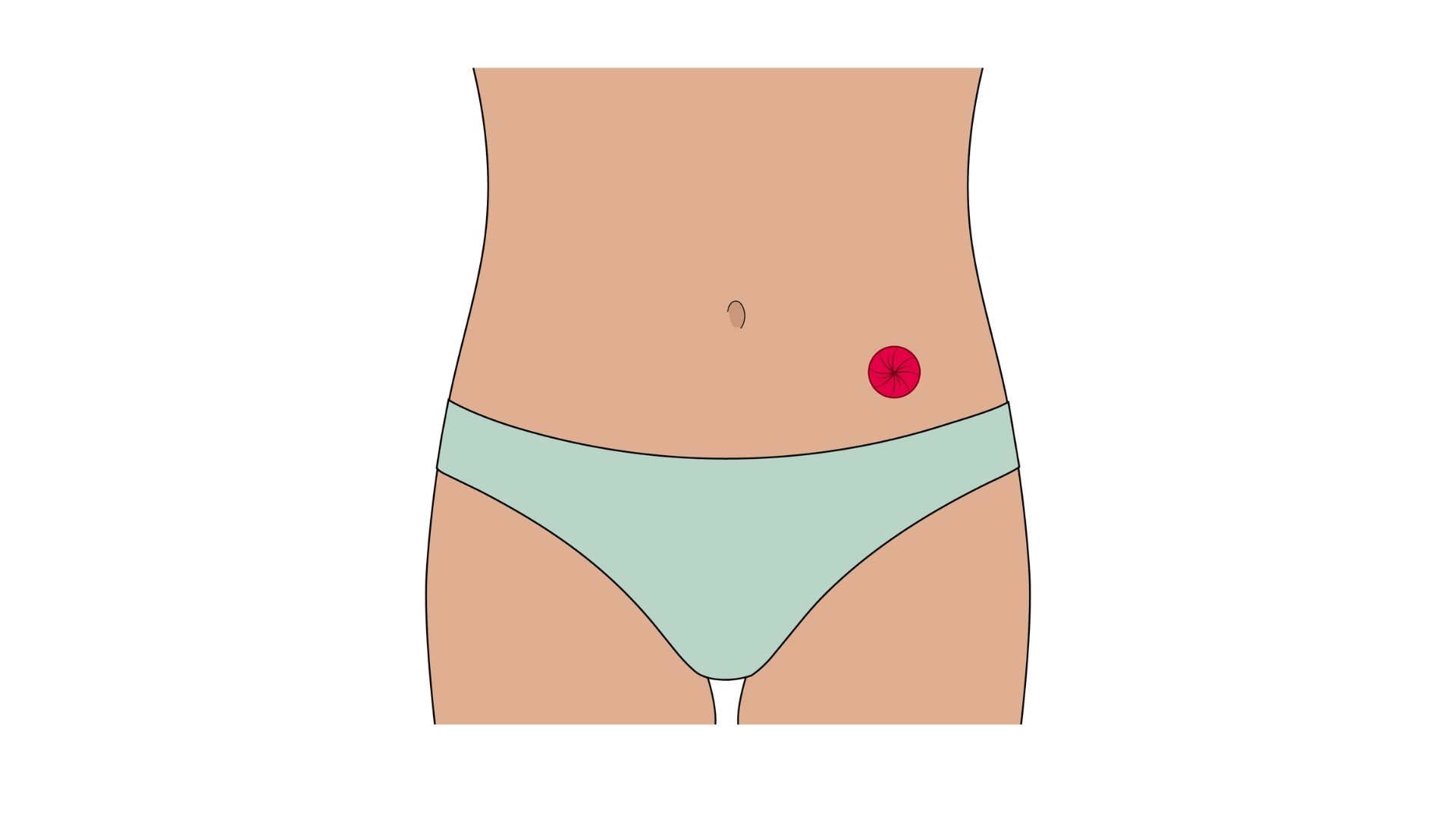  Anatomische illustratie van een colostoma. De afbeelding laat zien hoe een deel van de dikke darm via een stoma door de buikwand naar buiten wordt geleid. Het stoma is rood weergegeven, terwijl het lagere deel van de darm, dat niet langer wordt gebruikt voor de afvoer van ontlasting, vervaagd is afgebeeld.