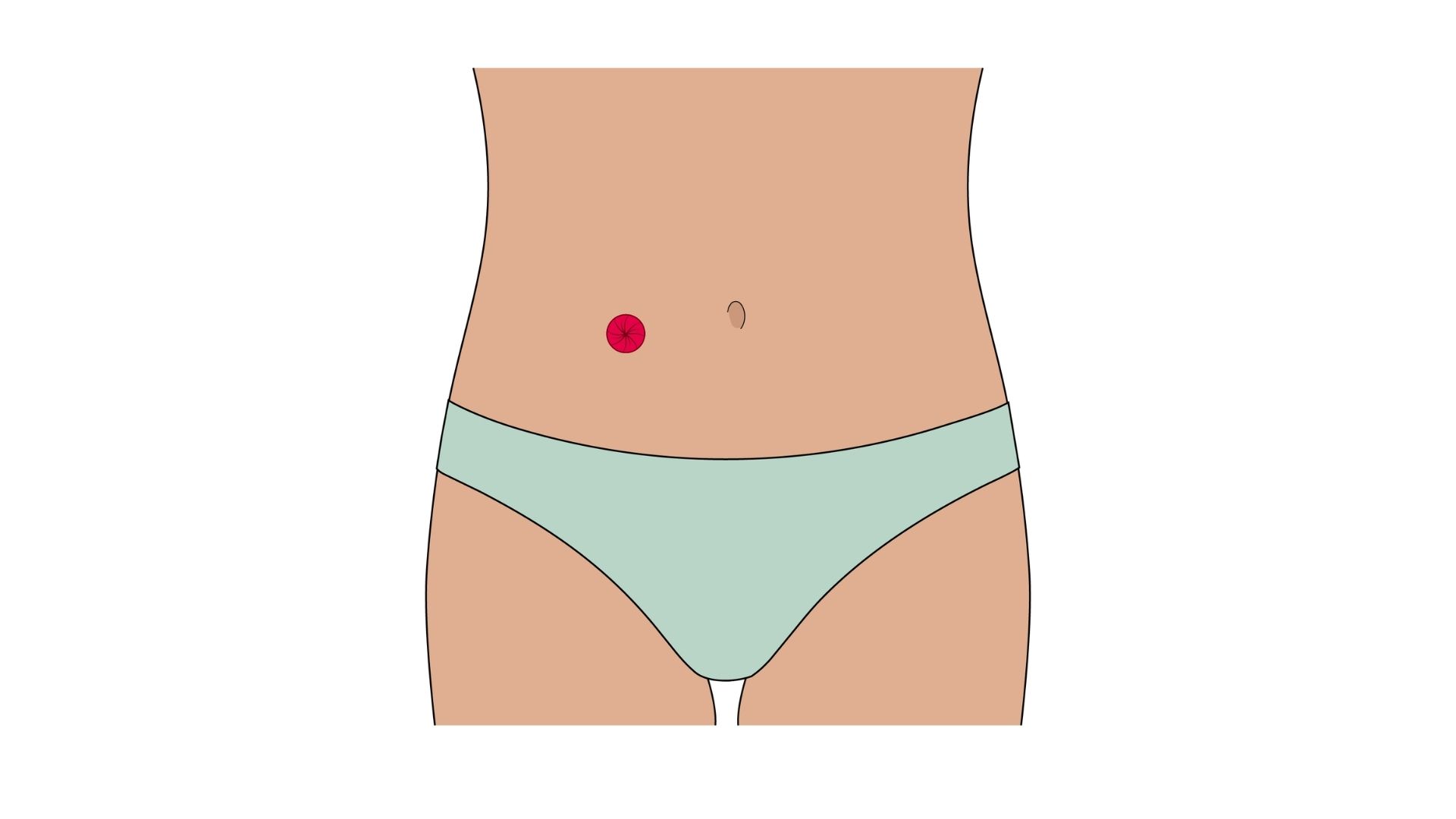  Een anatomische illustratie die de weergave van een ileostoma toont, waarbij wordt benadrukt hoe de stoma (in het rood weergegeven) de dunne darm (ileum) rechtstreeks met de buikwand verbindt, waarbij de hele dikke darm vervaagt.