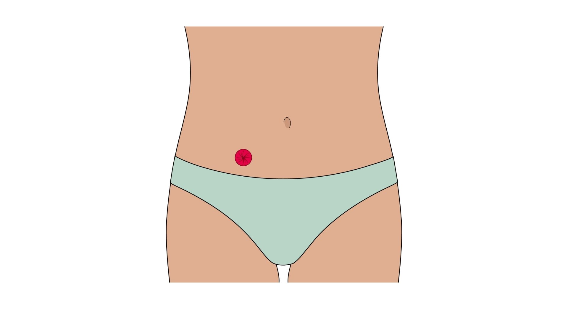 Anatomische illustratie van een urostoma met nieren, urineleiders en een rood weergegeven stoma in de buikwand. Het spijsverteringskanaal is vervaagd weergegeven.