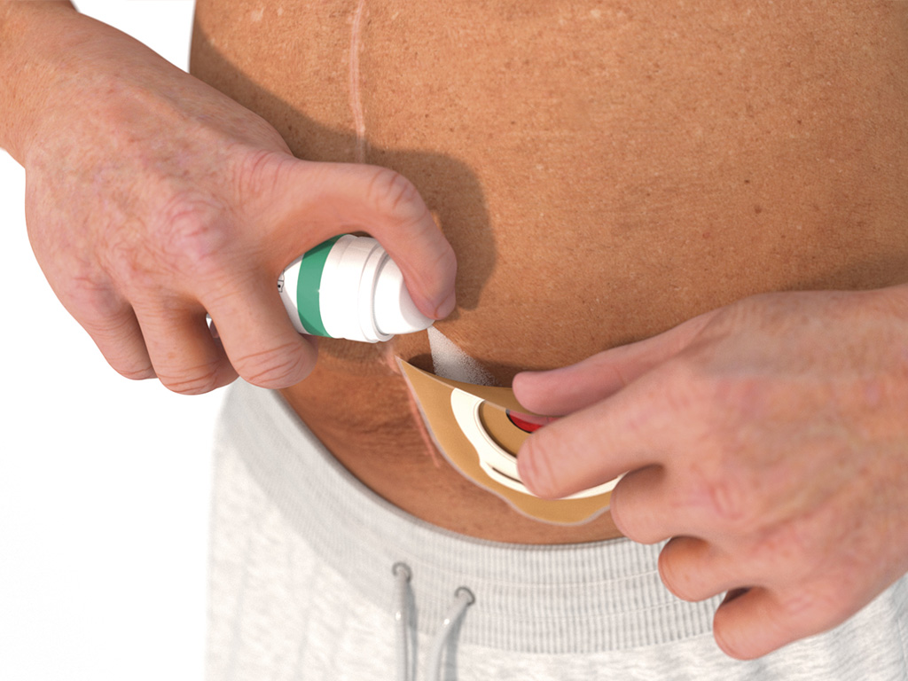 ally adhesive spray aanbrengen rondom stoma stap 2