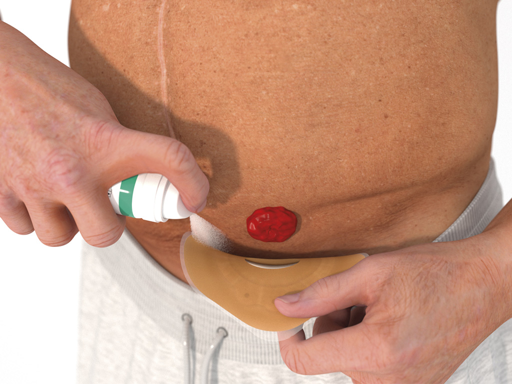 ally barrier spray rondom stoma aanbrengen stap 3