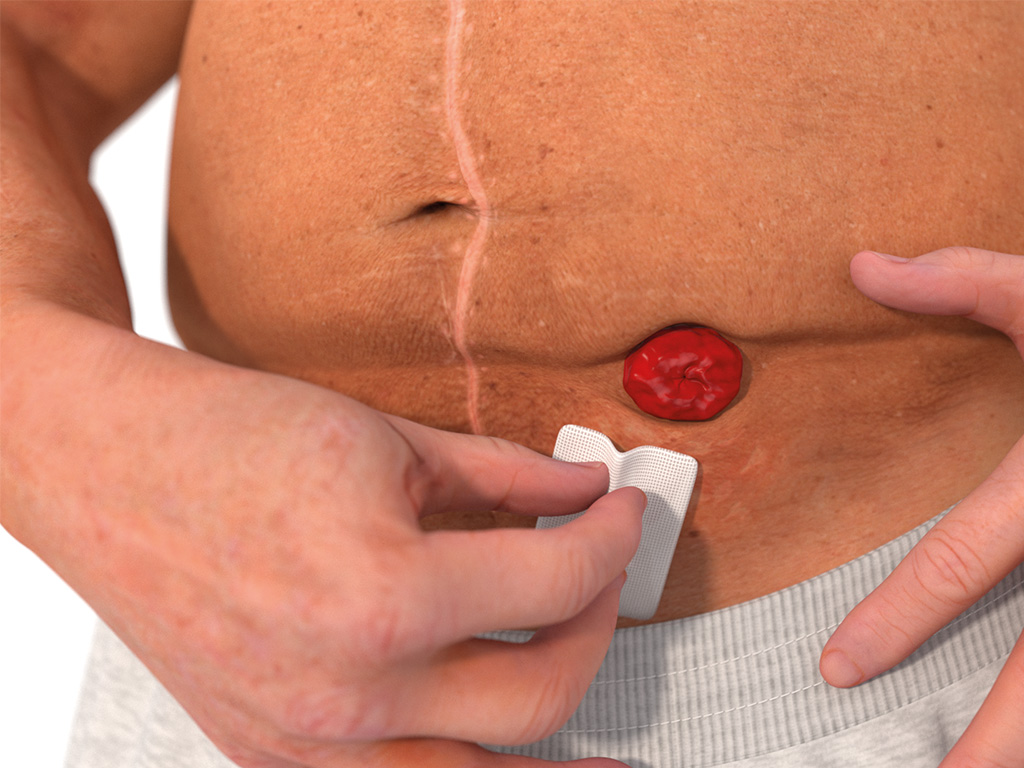 ally barrier spray aanbrengen op stoma stap 1