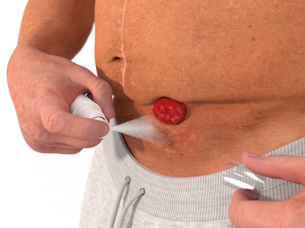 ally barrier spray aanbrengen rondom stoma stap 2