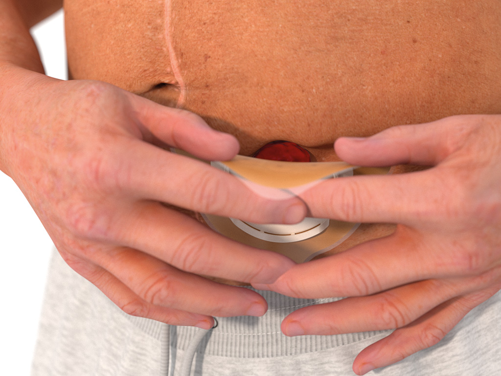 ally barrier spray rondom stoma aanbrengen stap 3